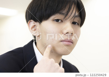 肌荒れを気にする男子学生 122250429