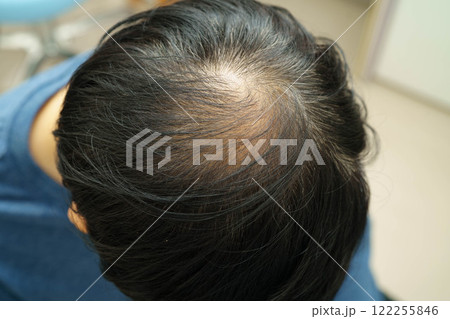 Bald head in man, hair loss treatment health problem. Bald head in man, hair loss treatment health problem. 122255846