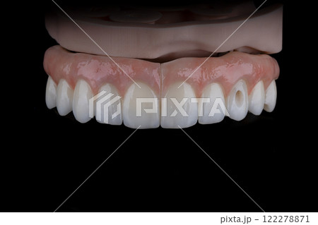 Full dental zirkonium prosthesis on titanium bar stained with stains for ceramic Full dental zirkonium prosthesis on titanium bar stained with stains for ceramic 122278871