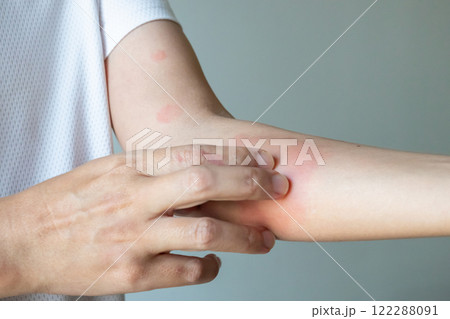 Young asian man itching and scratching on arm from allergic itchy dry skin eczema dermatitis insect bites Young asian man itching and scratching on arm from allergic itchy dry skin eczema dermatitis insect bites 122288091