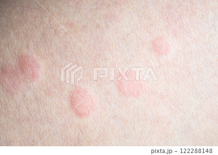 Skin allergy rash dermatitis texture close up Skin allergy rash dermatitis texture close up 122288148