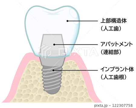 インプラント 122307758