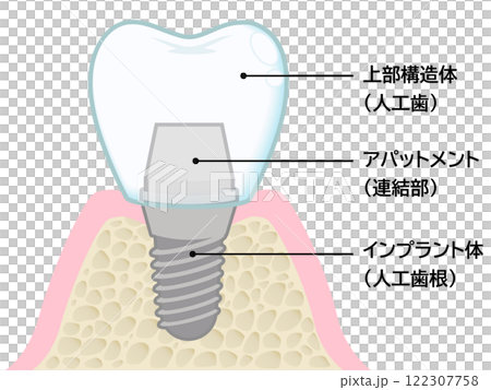 インプラント 122307758