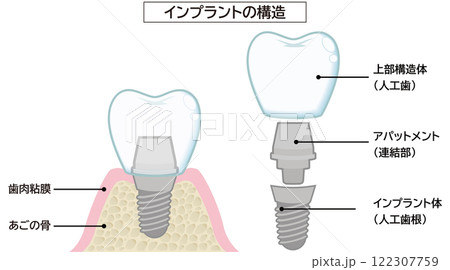 インプラント インプラント 122307759