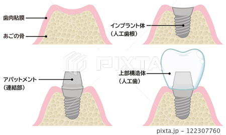 インプラント 122307760