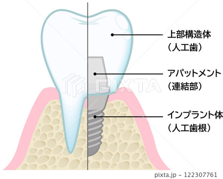 インプラント 122307761