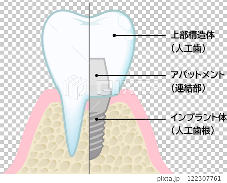 インプラント 122307761
