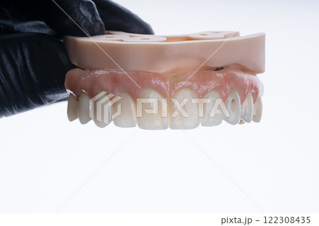 Full dental zirkonium prosthesis on titanium bar stained with stains for ceramic 122308435