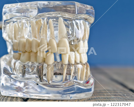 Full-Side View of a Transparent Dental Implant Model Featuring Artificial Teeth and Prosthetic Components 122317047
