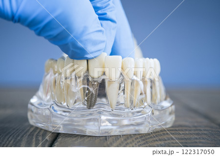 Side View of a Dental Implant Model with a Gloved Hand Adjusting Prosthetic Teeth on a Transparent Jaw for Clinical Side View of a Dental Implant Model with a Gloved Hand Adjusting Prosthetic Teeth on a Transparent Jaw for Clinical 122317050