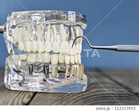 Transparent Dental Implant Model with Metal Dental Tool Demonstrating Prosthetic Teeth and Root Structure 122317053