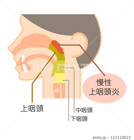 慢性上咽頭炎の説明図・カラー・図解_イラスト 122319015