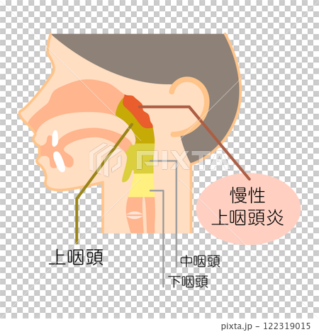 慢性上咽頭炎の説明図・カラー・図解_イラスト 122319015
