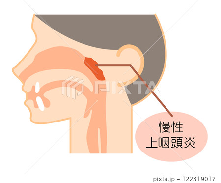 慢性上咽頭炎の説明図・カラー・シンプルな図解_イラスト 122319017
