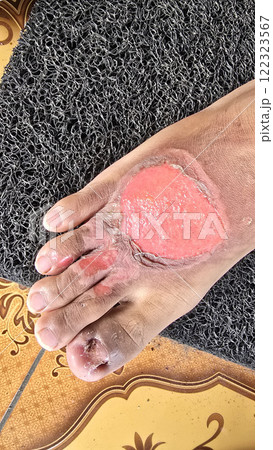 Second degree burns open wound, damage extends beyond the top layer of skin post blisters burst hick, soft, scab-like tissue called fibrinous exudate may develop over the wound 122323567