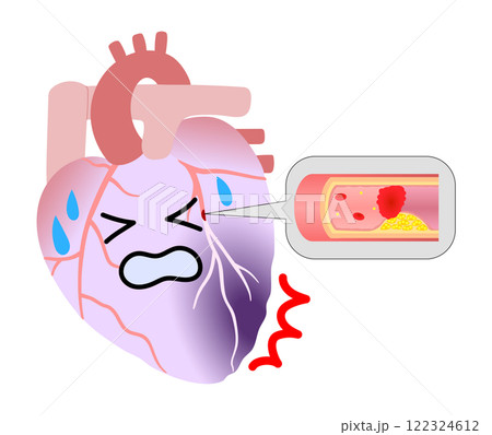 心筋梗塞になった苦しそうな心臓と血栓のイラスト 心筋梗塞になった苦しそうな心臓と血栓のイラスト 122324612