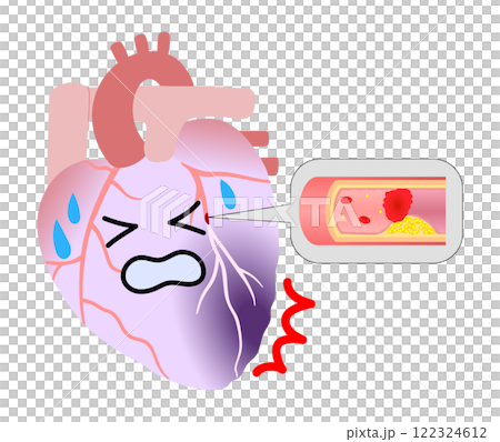 心筋梗塞になった苦しそうな心臓と血栓のイラスト 心筋梗塞になった苦しそうな心臓と血栓のイラスト 122324612