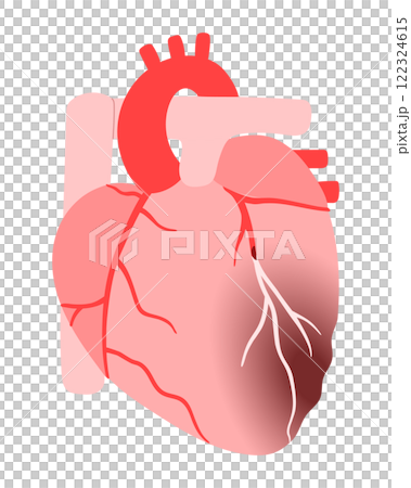 血栓で冠動脈が詰まり心筋梗塞を起こした心臓のイラスト 血栓で冠動脈が詰まり心筋梗塞を起こした心臓のイラスト 122324615