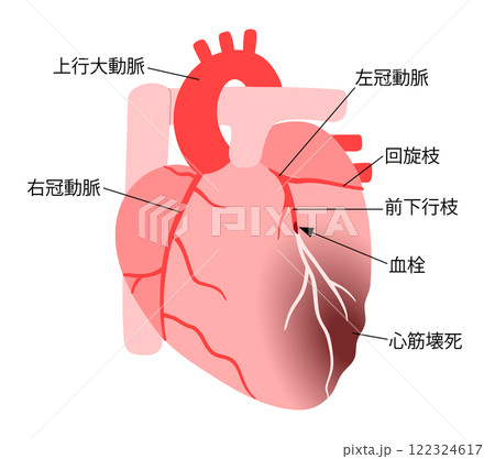 血栓で冠動脈が詰まり心筋梗塞を起こした心臓の説明入りイラスト 血栓で冠動脈が詰まり心筋梗塞を起こした心臓の説明入りイラスト 122324617
