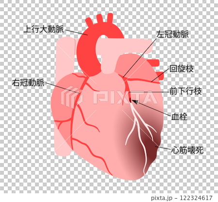 血栓で冠動脈が詰まり心筋梗塞を起こした心臓の説明入りイラスト 血栓で冠動脈が詰まり心筋梗塞を起こした心臓の説明入りイラスト 122324617