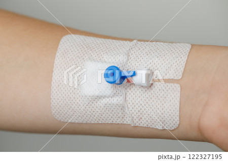 Medical device. Peripheral Catheter for Multiday Therapy Medical device. Peripheral Catheter for Multiday Therapy 122327195