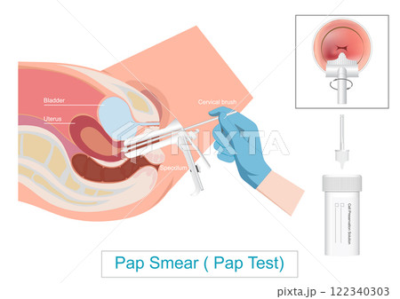 Pap Test ( Pap Smear ) Cervical Cancer Screening. 122340303