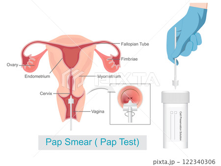 Sampling the endocervix using the cervical brush and cell. 122340306