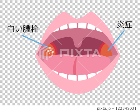 扁桃炎の説明図・説明イラスト素材 扁桃炎の説明図・説明イラスト素材 122345031