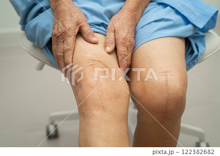 Asian elderly woman patient with scar knee replacement surgery in hospital. 122382682