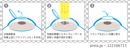 3-step guide to LASIK surgery - Japanese - 122386715