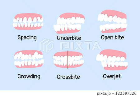 spacing, underbite, open bite, crowding, crossbite, overjet list of orthodontic dental problem 122397326