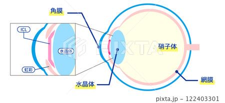 ICL手術の解剖学的図解-日本語- 122403301
