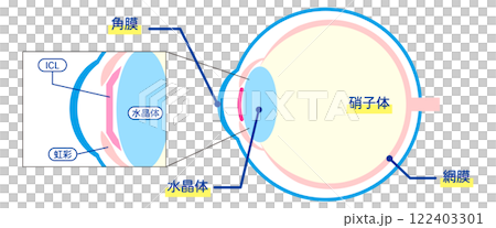 ICL手術の解剖学的図解-日本語- 122403301