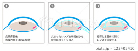 ICL手術の工程図解-日本語- 122403410