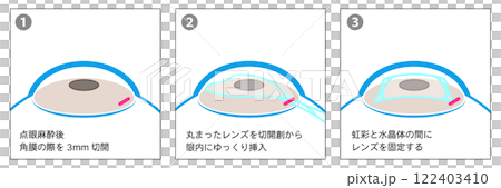 ICL手術の工程図解-日本語- 122403410