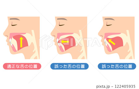 適正な舌の位置と誤った舌の位置　ミューイング 122405935