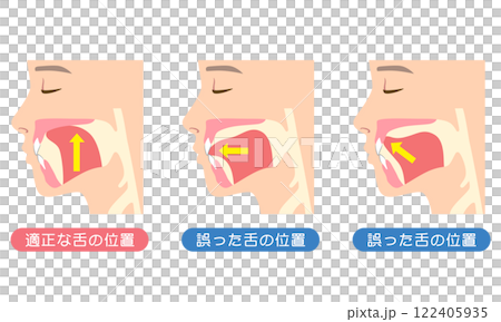 Proper and incorrect tongue position - Mewing 122405935