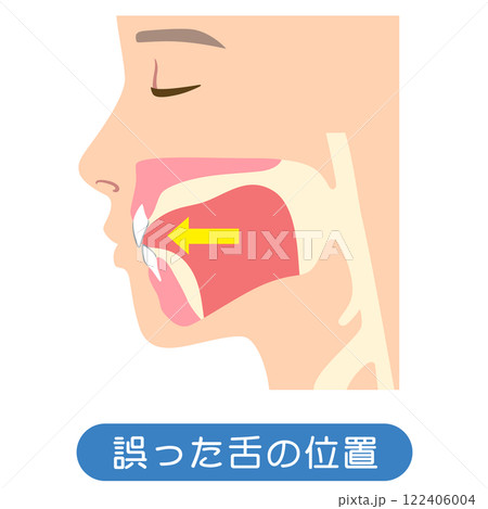 誤った舌の位置　下がっている舌の位置 122406004