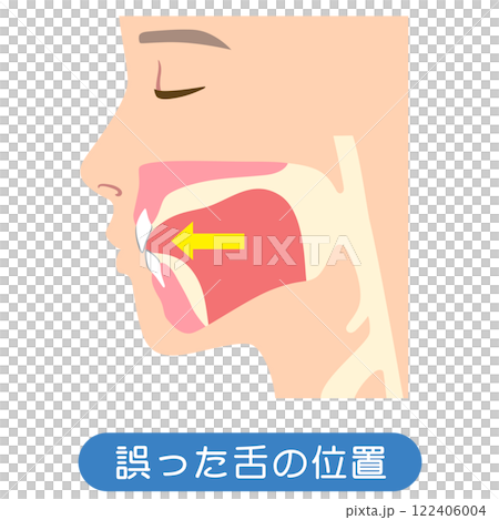 誤った舌の位置　下がっている舌の位置 122406004