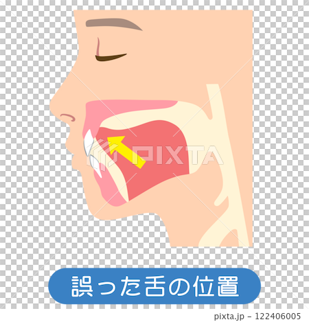Incorrect tongue position: Lowered tongue position 122406005