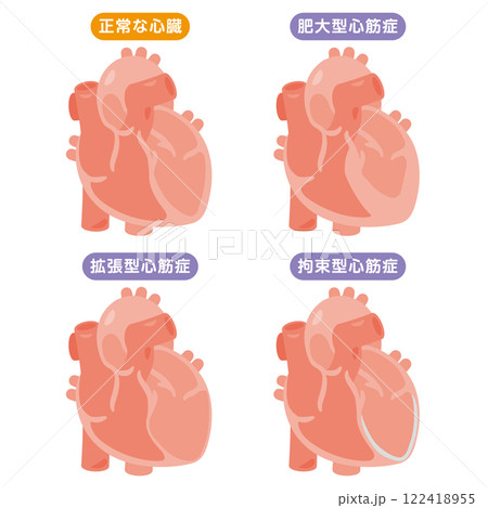 正常な心臓と心筋症の心臓イラストセット 122418955