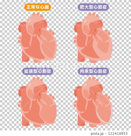 正常な心臓と心筋症の心臓イラストセット 122418955