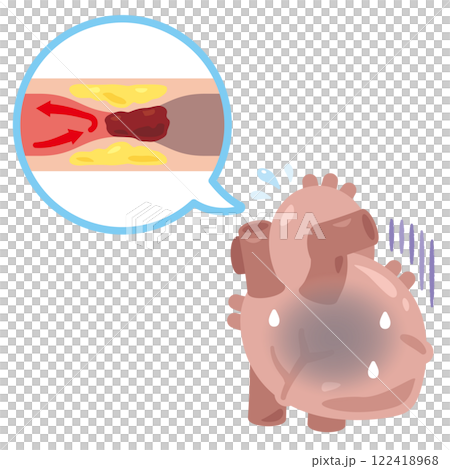 Illustration of a heart with clogged blood vessels causing a stroke Illustration of a heart with clogged blood vessels causing a stroke 122418968