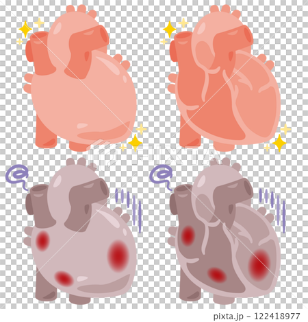 Illustration of a healthy and beautiful heart and an unhealthy heart with inflammation 122418977