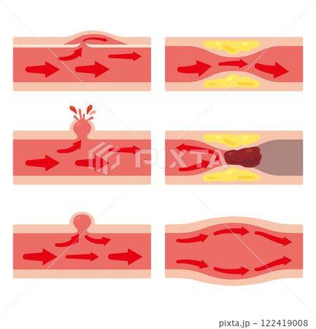 様々な状態の血管イラストセット1 様々な状態の血管イラストセット1 122419008