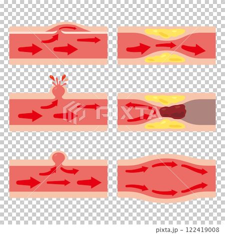 各種條件下的血管插圖集 1 各種條件下的血管插圖集 1 122419008