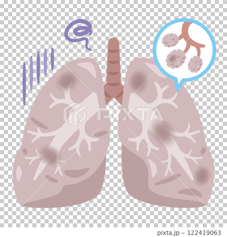 Illustration of lungs with dirty bronchi and alveoli 122419063