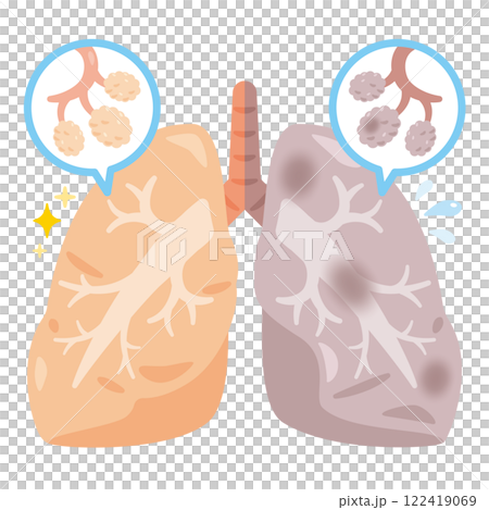 Illustration of half a clean lung and half a dirty lung 122419069