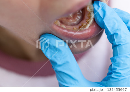 An appointment with a dentist for dental cleaning. Closeup. An appointment with a dentist for dental cleaning. Closeup. 122455667
