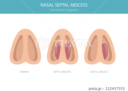 Nasal septal abscess. Nasal diseases. Medical infographic design Nasal septal abscess. Nasal diseases. Medical infographic design 122457353